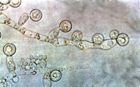 Vaginal Candidiasis Microscopy