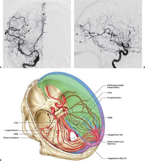Endovascular Management Of Intracranial Dural Arteriovenous Fistulas