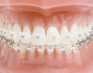 verdade ou mito aparelho ortodontico estetico quebra mais