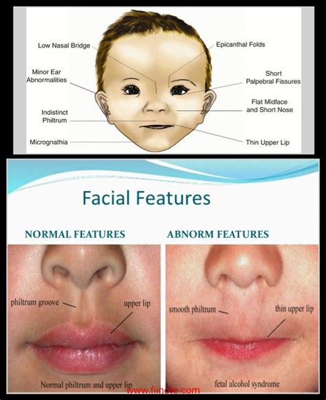Increased space between 1st and 2nd toes; Flat Nasal Bridge And Epicanthal Folds / The epicanthic or ...