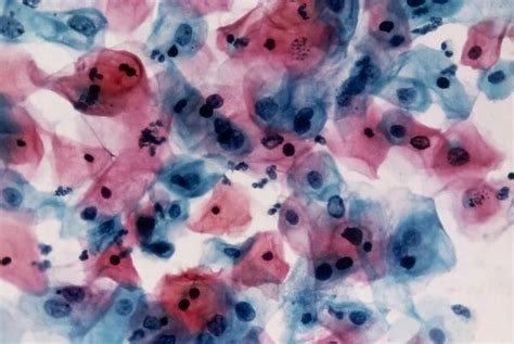 Lm Of Cervical Smear Cells With Mild Dyskaryosis Photos Framed Prints