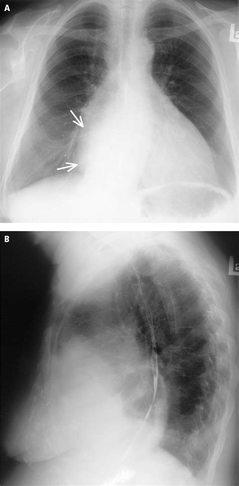 Figure 0314131 Chest Radiography Of A Patient With Combined Tricuspid