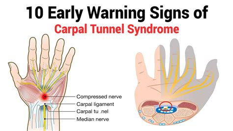 Carpal Tunnel Syndrome Hetyplant