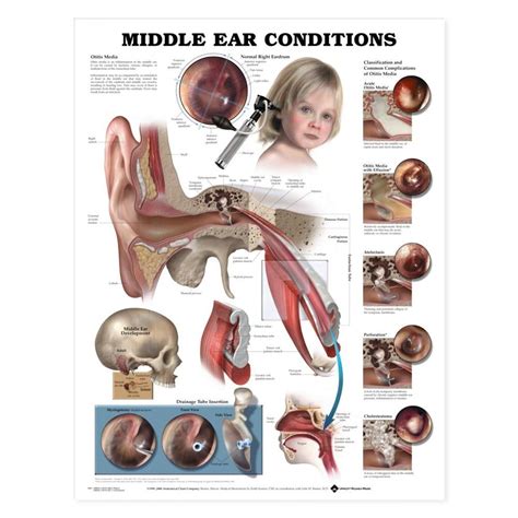 Middle Ear Conditions Chart Poster Laminated Middle Ear
