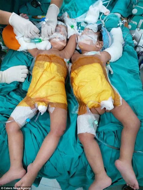 Conjoined Twins From Mumbai Successfully Separated Daily Mail Online
