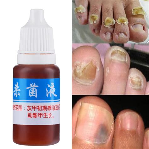 10ml Nail Fungus Treatment Cream Onychomycosis Paronychia Anti Fungal