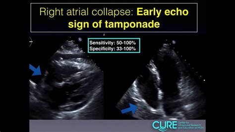 Pericardial Tamponade Ultrasound