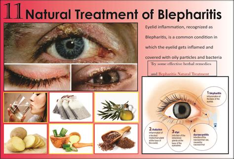 11 Best Natural Treatments Of Blepharitis Blepharitis Natural