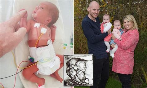 miracle twin girls defy 5 survival odds after doctors perform life saving surgery in the womb