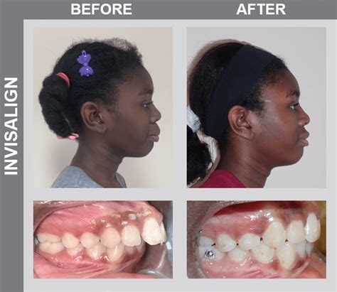 Smile Gallery Before And Afters Ncoso Orthodontics