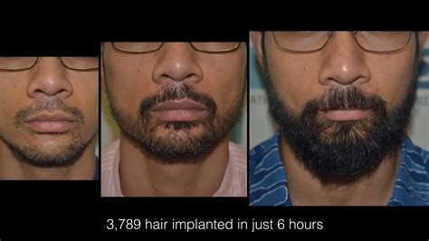 Best Beard Transplant Clinic Dhi Direct Technique Beard Transplant