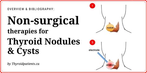 Non Surgical Therapies For Thyroid Nodules And Cysts Thyroid Patients