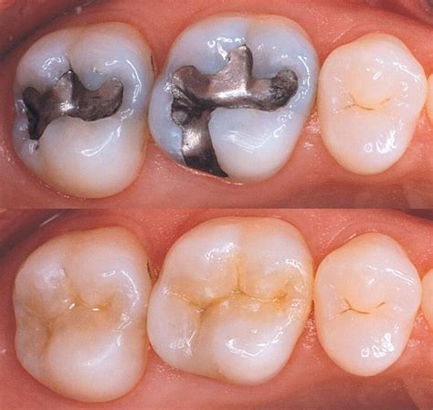 White Fillings Dentist Mcmurray Pa Omni Dental