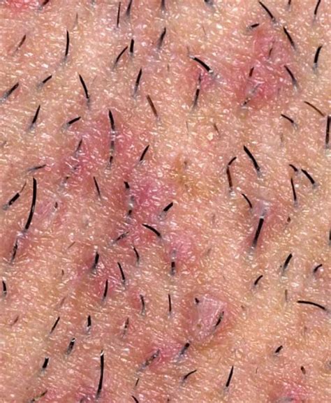 Get Rid Of Ingrown Hair Musely