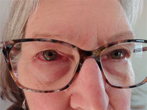 Update: My eyes are aligned | Minnesota Prairie Roots