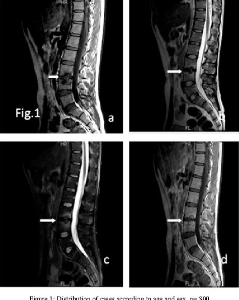 Pdf Spinal Changes In Patients With Ankylosing Spondylitis On Mri