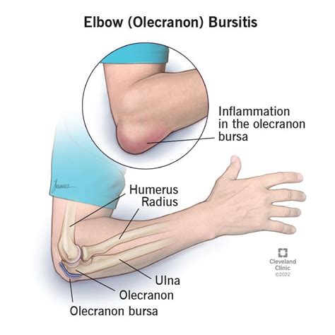 Elbow Olecranon Bursitis Symptoms Causes And Treatment In 2022