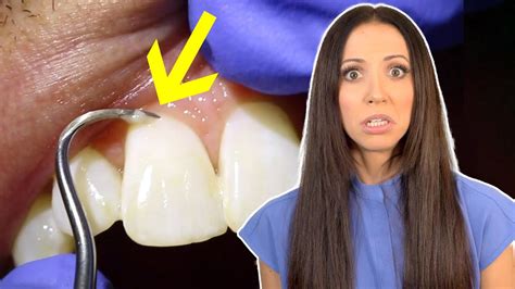 Can Scaling Teeth Ruin Your Tooth Enamel YouTube