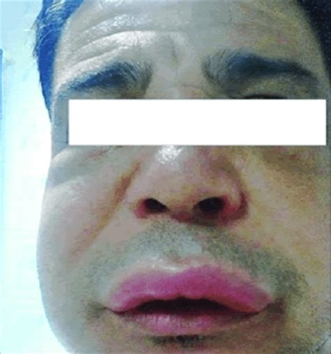 Angioedema Of The Face Most Strikingly In The Upper Lip Boussetta N
