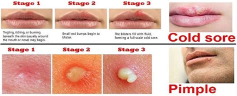 Cold Sore Vs Pimple How To Tell The Difference Zohal