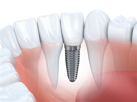 What Is Bone Grafting For Dental Implants