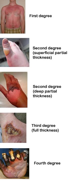 The Different Degrees Of Burn Wounds According To Ski