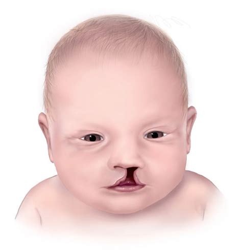 Symptoms Causes And Treatment Of Trisomy 13 The Point