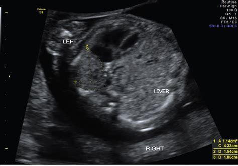 Diaphragmatic Hernia Fetal Ultrasound