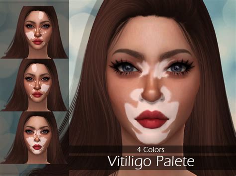 Sims 4 Vitiligo Skin Cc