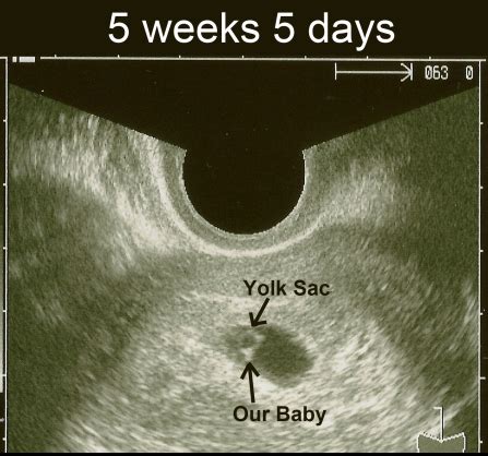 Home pregnancy week by week 5 weeks pregnant. Mommy in the Making: First Ultrasound! 5 weeks 5 days