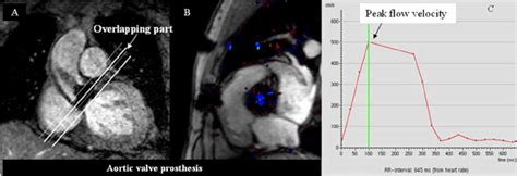 A Prosthetic Aortic Valve Stenosis Evaluation By Fl Ow Measurement