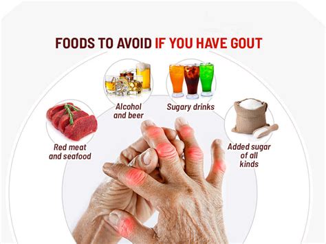 Foods To Avoid With Gout Shanghai Medical Clinic