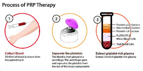 The Procedure Of Separation Of Platelet Rich Plasma From The Venous