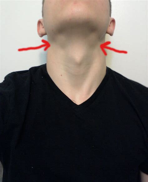 Why Are The Glands Under My Jaw Swollen Yahoo Answers