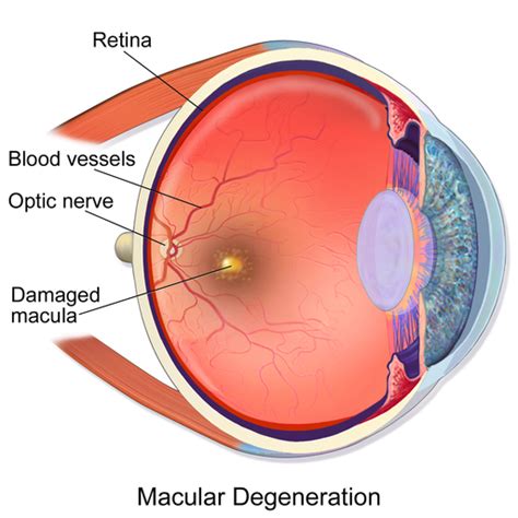 Age Related Macular Degeneration Treatment And Therapies Eye Ear