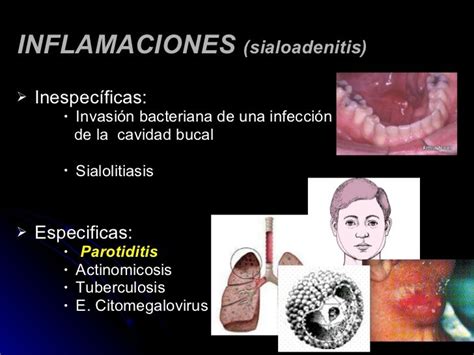 Patologia De Las Glandulas Salivales