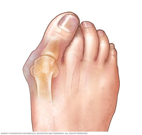 Corns And Calluses Symptoms And Causes Mayo Clinic