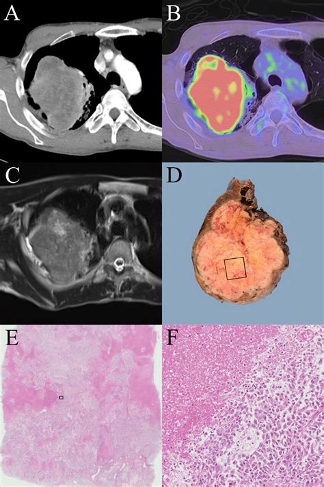 A Contrast Enhanced Chest Ct Shows A Heterodense Lobulated Mass In