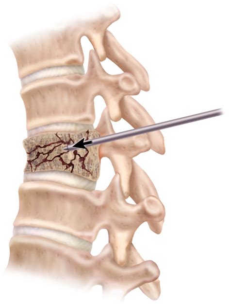 Fractura Por Aplastamiento Vertebral Reus Y Tarragona Traumat Logos