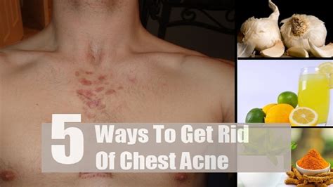 5 Home Remedies To Get Rid Of Chest Acne By Top 5 Youtube