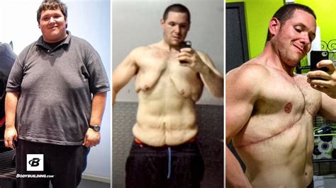 400 Pound Man Has To Start Over After Skin Surgery Jordan Grahms