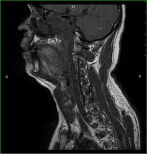 Adenoid Cystic Carcinoma Sphenoid Sinus Neuro Mr Case Studies