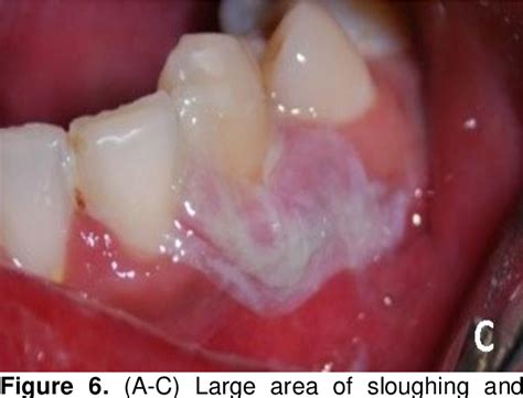 Figure 2 From Oral Mucosal Burn Caused By Topical Application Of 36