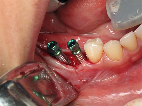Dental Implant Surgery Infographic Dental Implant Sur