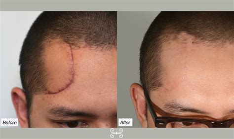 Forehead Scar 6months Charleston Facial Plastic Surgery