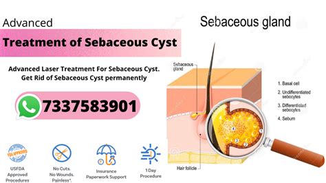 Best Treatment For Sebaceous Cyst In Hyderabad At Affordable Cost