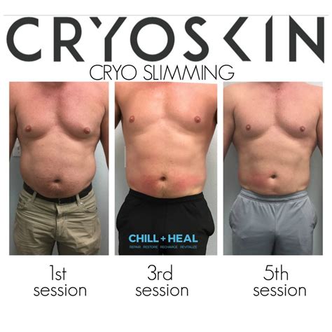 Cryo Toning Before And After