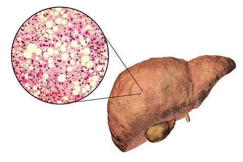 Study Shows Fatty Liver Disease Is A Significant Risk Factor For Covid