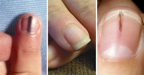You Should Never Ignore These 9 Things Your Fingernails Reveal About