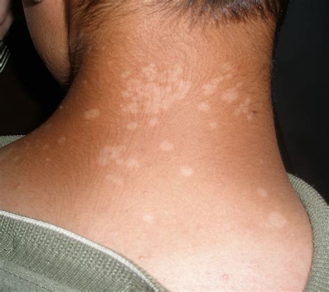 Tinea Versicolor A Cause Of Circular Patches On The Trunk And Face